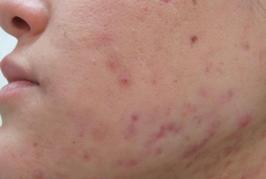 trattamenti viso per cicatrici acne